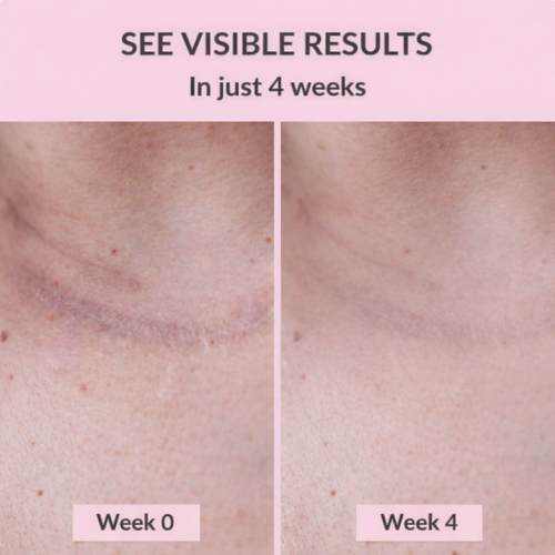 Scarlette™ Silicone Scar Sheets