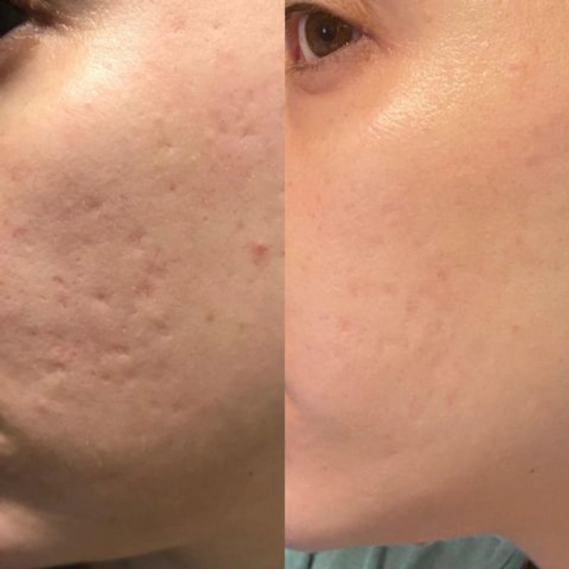 Scarlette™ Silicone Scar Sheets